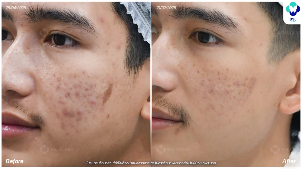 รีวิว ก่อนและหลัง โปรแกรมรักษาสิว รอยสิว หลุมสิว