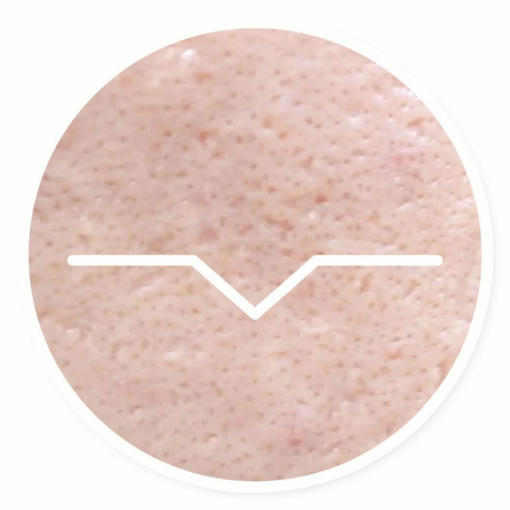 ประเภท-หลุมสิวลุก-ปากแคบ-ice-pick-scars