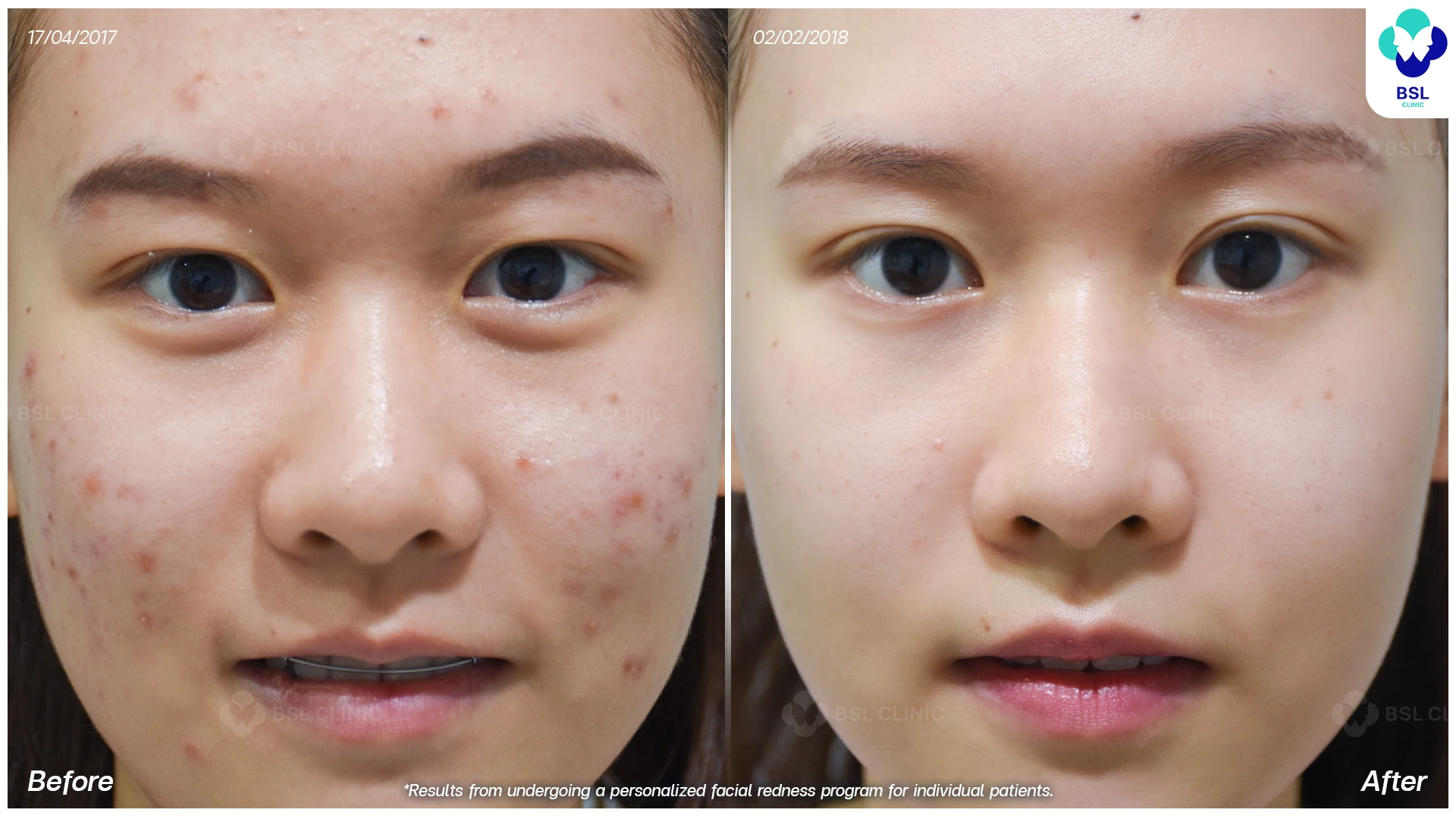รีวิวเลเซอร์รอยแดงสิว-เห็นผลไหม-BA-เลเซอร์สิว