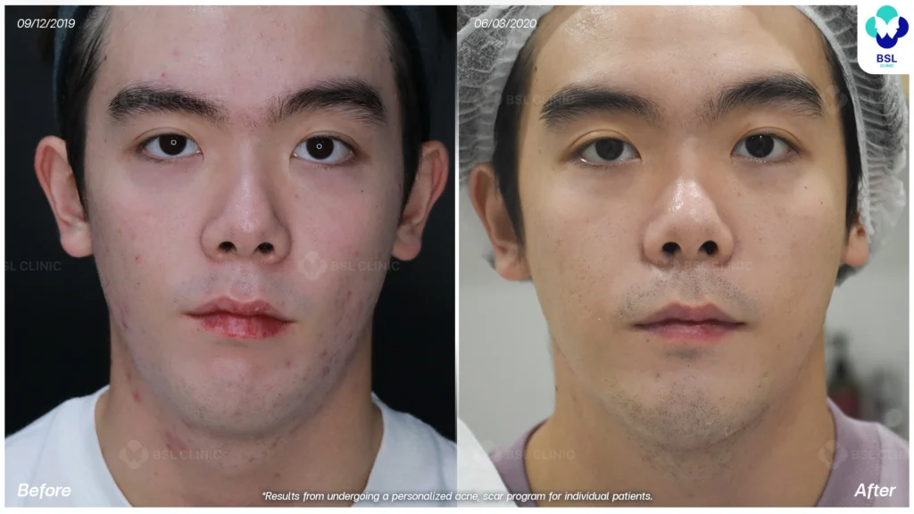 รีวิว ก่อนและหลัง โปรแกรมรักษาสิว รอยสิว หลุมสิว