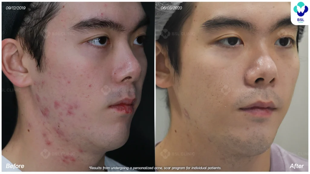 รีวิว ก่อนและหลัง โปรแกรมรักษาสิว รอยสิว หลุมสิว