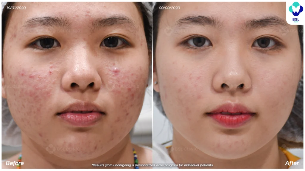 รีวิว ก่อนและหลัง โปรแกรมรักษาสิว รอยสิว หลุมสิว