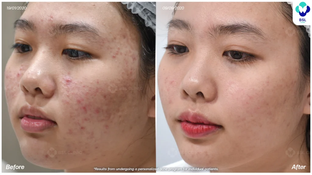 รีวิว ก่อนและหลัง โปรแกรมรักษาสิว รอยสิว หลุมสิว