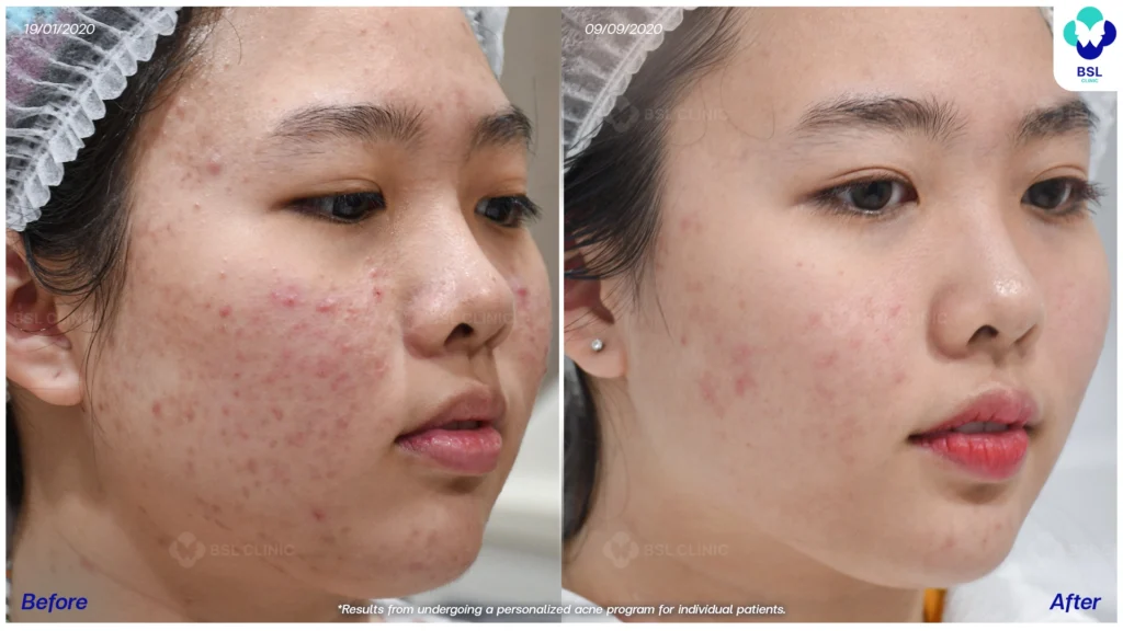 รีวิว ก่อนและหลัง โปรแกรมรักษาสิว รอยสิว หลุมสิว