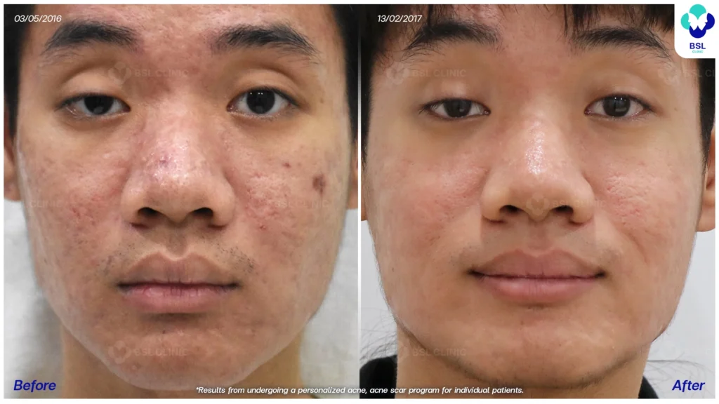 รีวิว ก่อนและหลัง โปรแกรมรักษาสิว รอยสิว หลุมสิว