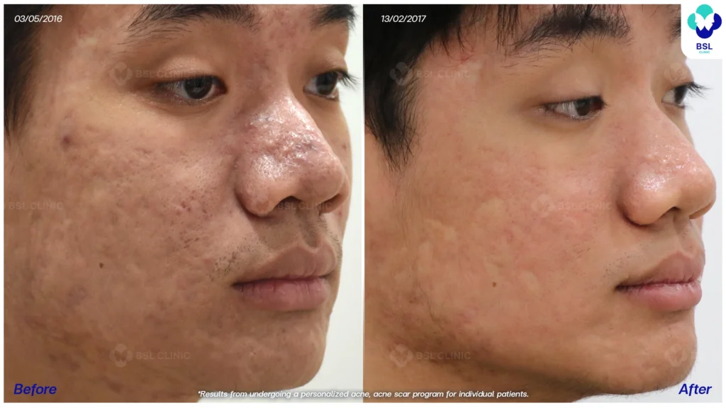 รีวิว ก่อนและหลัง โปรแกรมรักษาสิว รอยสิว หลุมสิว