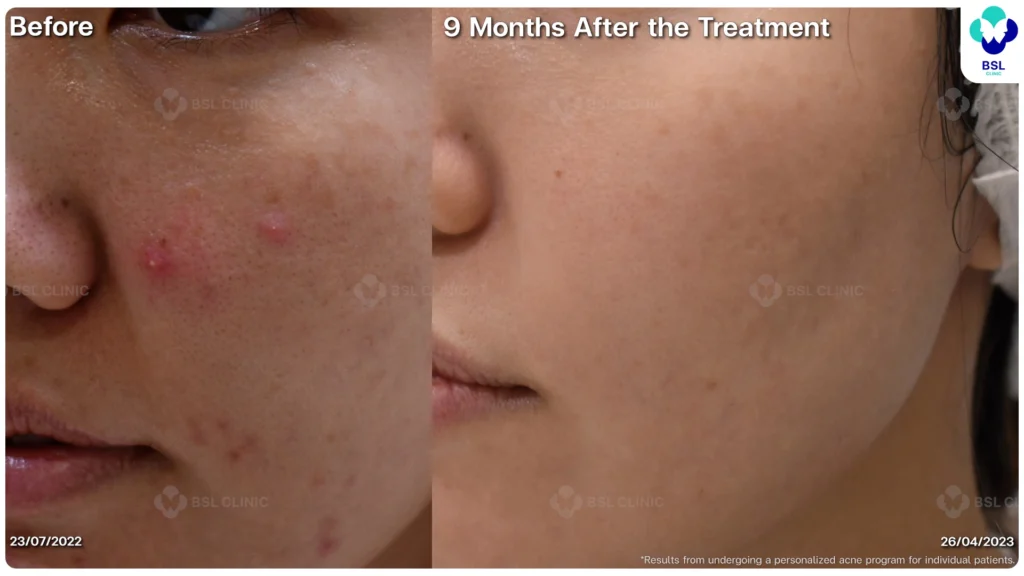 รีวิว ก่อนและหลัง โปรแกรมรักษาสิว รอยสิว หลุมสิว