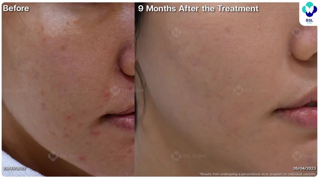 รีวิว ก่อนและหลัง โปรแกรมรักษาสิว รอยสิว หลุมสิว