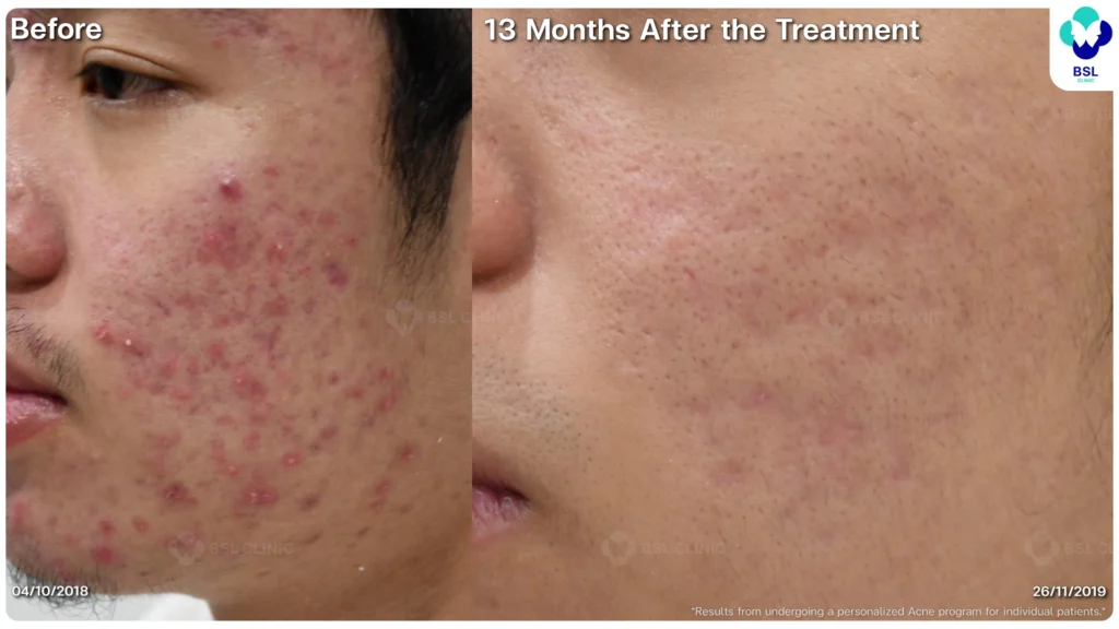 รีวิว ก่อนและหลัง โปรแกรมรักษาสิว รอยสิว หลุมสิว