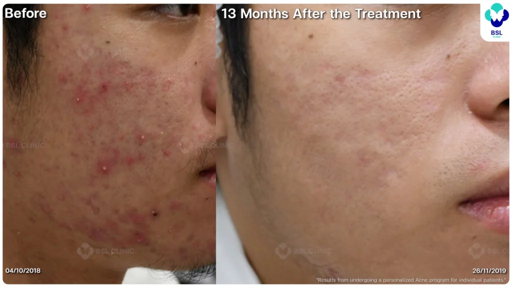 รีวิว ก่อนและหลัง โปรแกรมรักษาสิว รอยสิว หลุมสิว