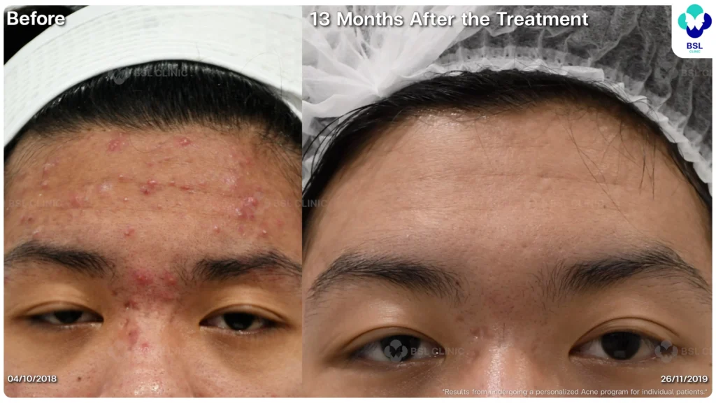 รีวิว ก่อนและหลัง โปรแกรมรักษาสิว รอยสิว หลุมสิว