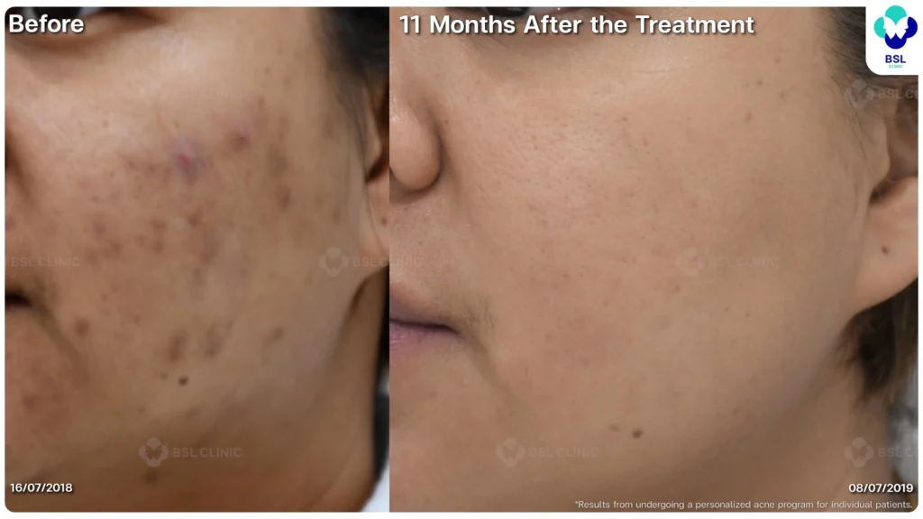 รีวิว ก่อนและหลัง โปรแกรมรักษาสิว รอยสิว หลุมสิว