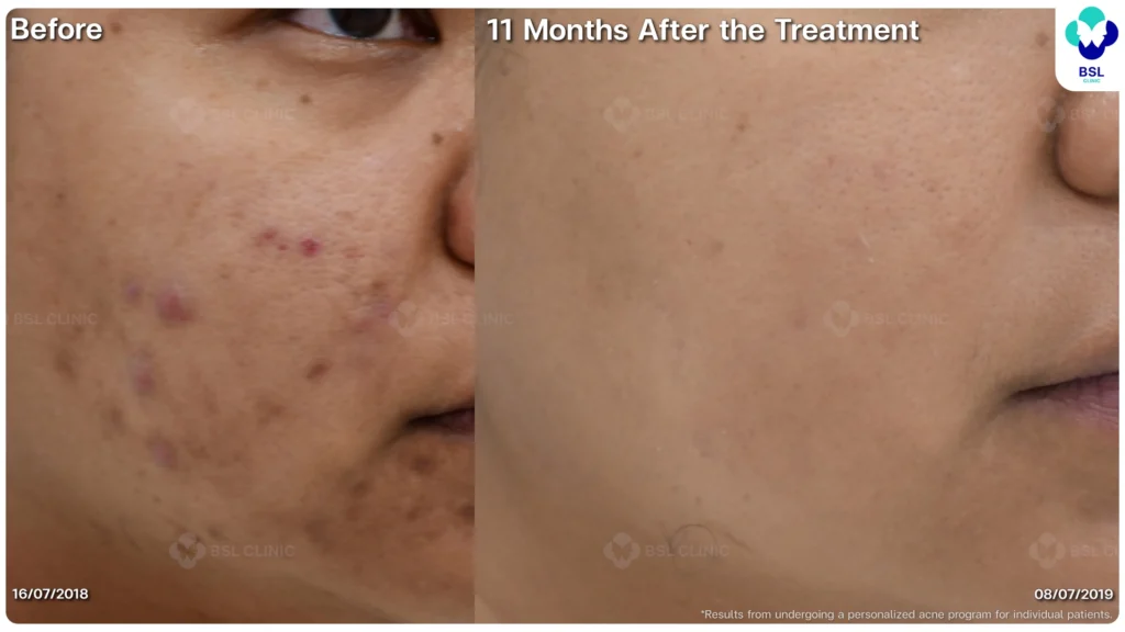 รีวิว ก่อนและหลัง โปรแกรมรักษาสิว รอยสิว หลุมสิว