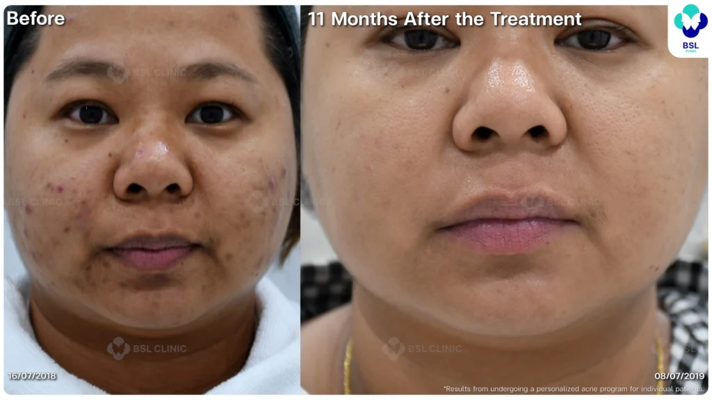 รีวิว ก่อนและหลัง โปรแกรมรักษาสิว รอยสิว หลุมสิว