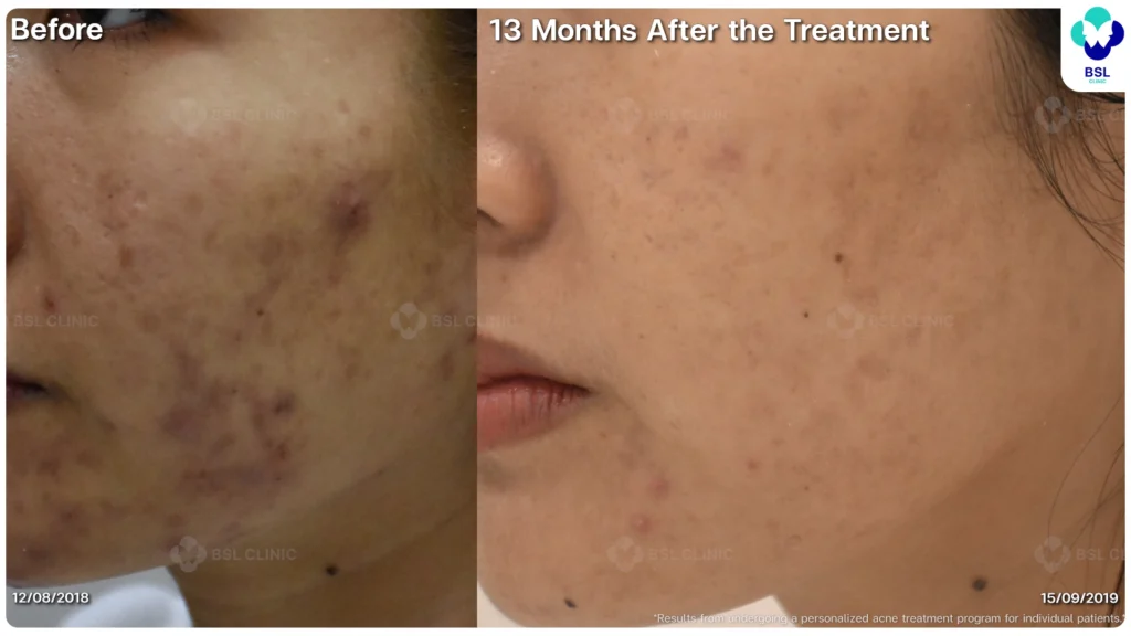 รีวิว ก่อนและหลัง โปรแกรมรักษาสิว รอยสิว หลุมสิว