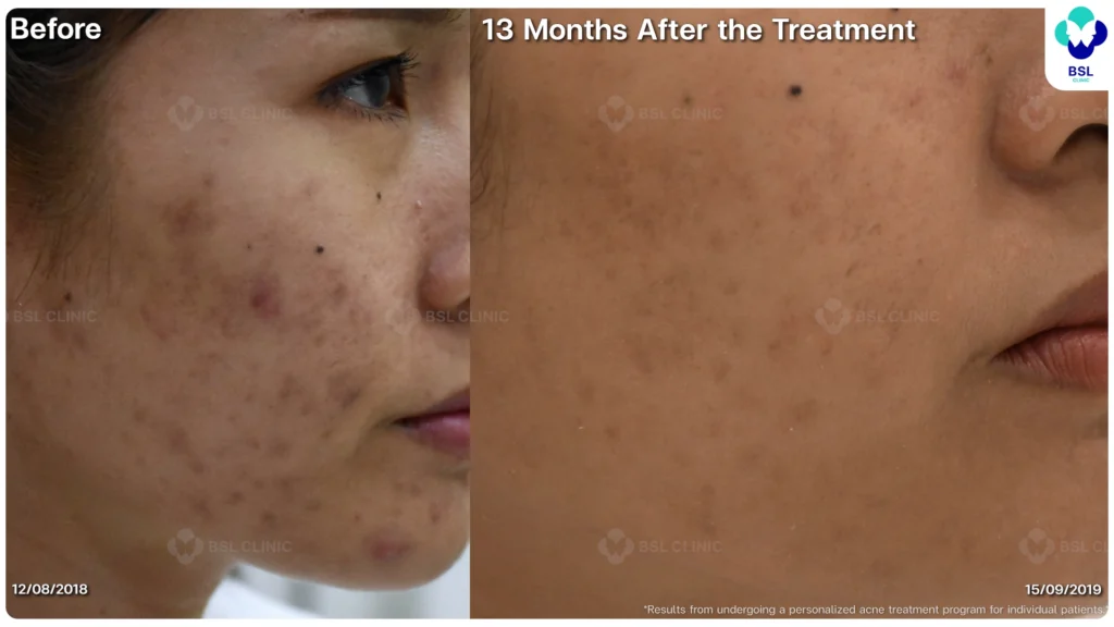 รีวิว ก่อนและหลัง โปรแกรมรักษาสิว รอยสิว หลุมสิว