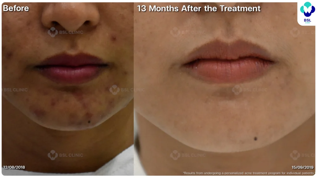 รีวิว ก่อนและหลัง โปรแกรมรักษาสิว รอยสิว หลุมสิว