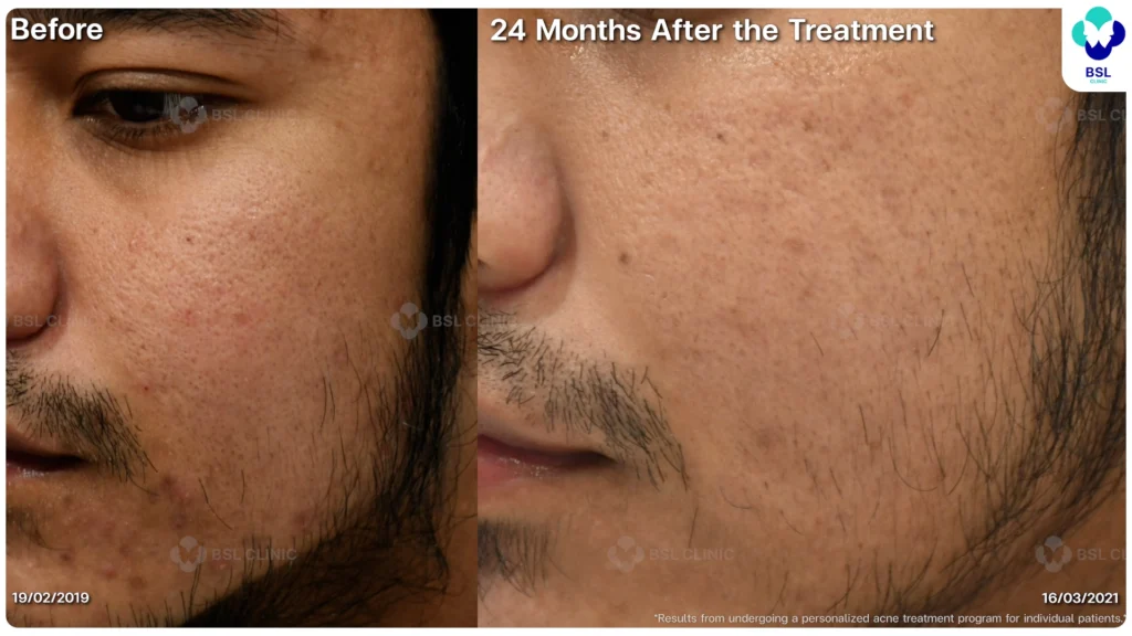 รีวิว ก่อนและหลัง โปรแกรมรักษาสิว รอยสิว หลุมสิว