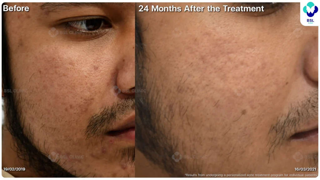 รีวิว ก่อนและหลัง โปรแกรมรักษาสิว รอยสิว หลุมสิว