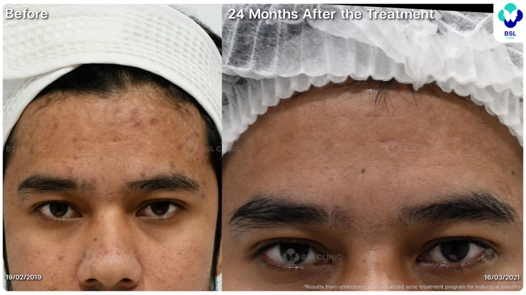 รีวิว ก่อนและหลัง โปรแกรมรักษาสิว รอยสิว หลุมสิว