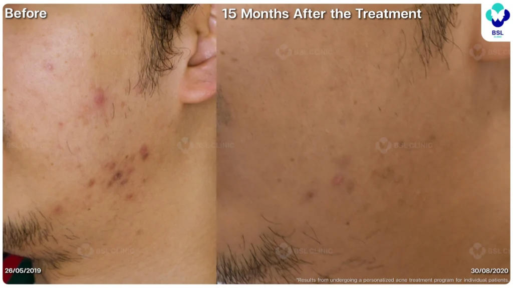 รีวิว ก่อนและหลัง โปรแกรมรักษาสิว รอยสิว หลุมสิว