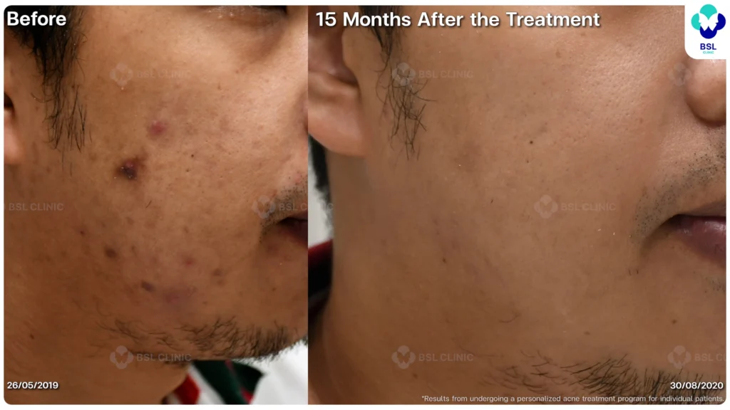 รีวิว ก่อนและหลัง โปรแกรมรักษาสิว รอยสิว หลุมสิว