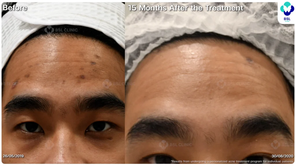 รีวิว ก่อนและหลัง โปรแกรมรักษาสิว รอยสิว หลุมสิว