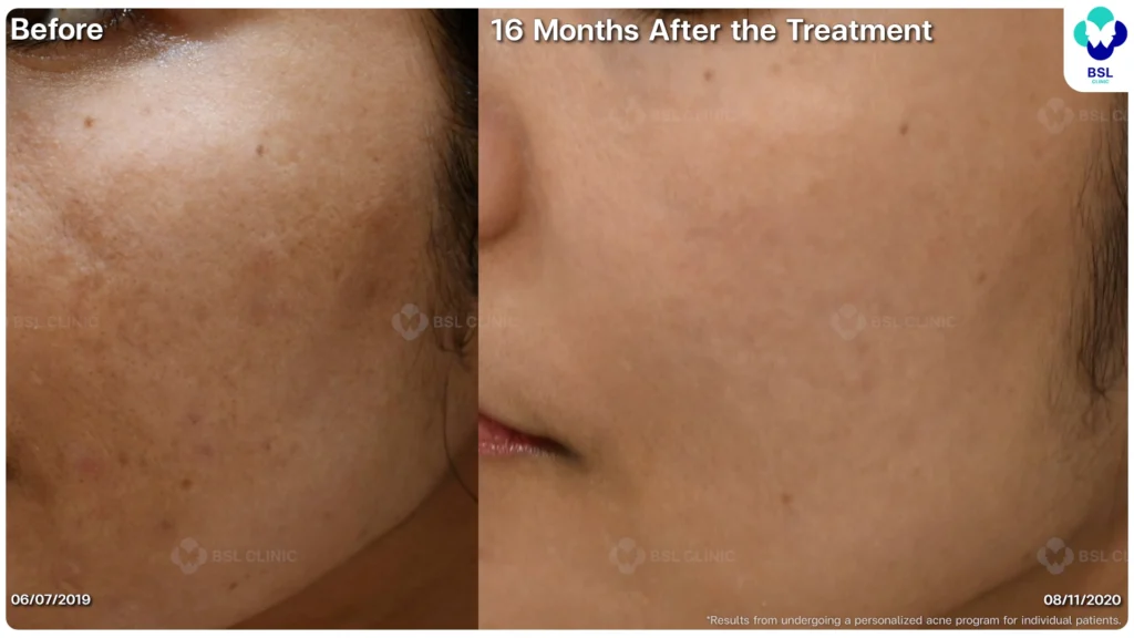 รีวิว ก่อนและหลัง โปรแกรมรักษาสิว รอยสิว หลุมสิว