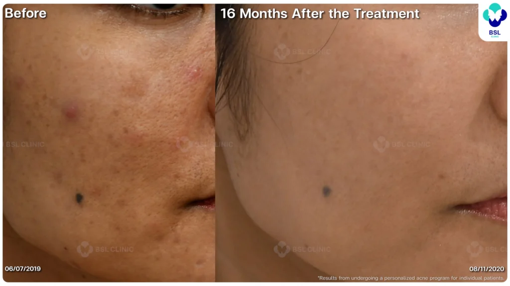 รีวิว ก่อนและหลัง โปรแกรมรักษาสิว รอยสิว หลุมสิว