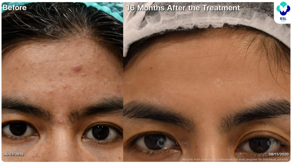 รีวิว ก่อนและหลัง โปรแกรมรักษาสิว รอยสิว หลุมสิว