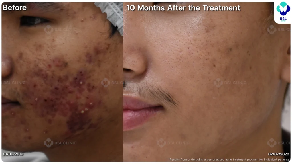 รีวิว ก่อนและหลัง โปรแกรมรักษาสิว รอยสิว หลุมสิว