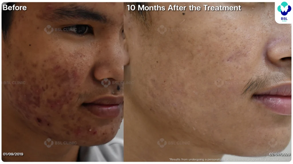 รีวิว ก่อนและหลัง โปรแกรมรักษาสิว รอยสิว หลุมสิว