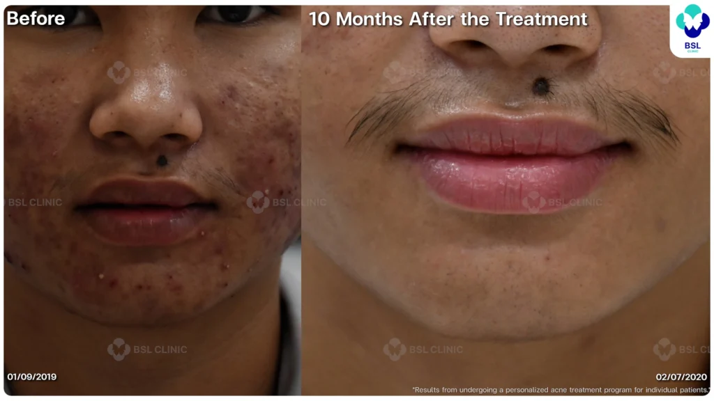 รีวิว ก่อนและหลัง โปรแกรมรักษาสิว รอยสิว หลุมสิว