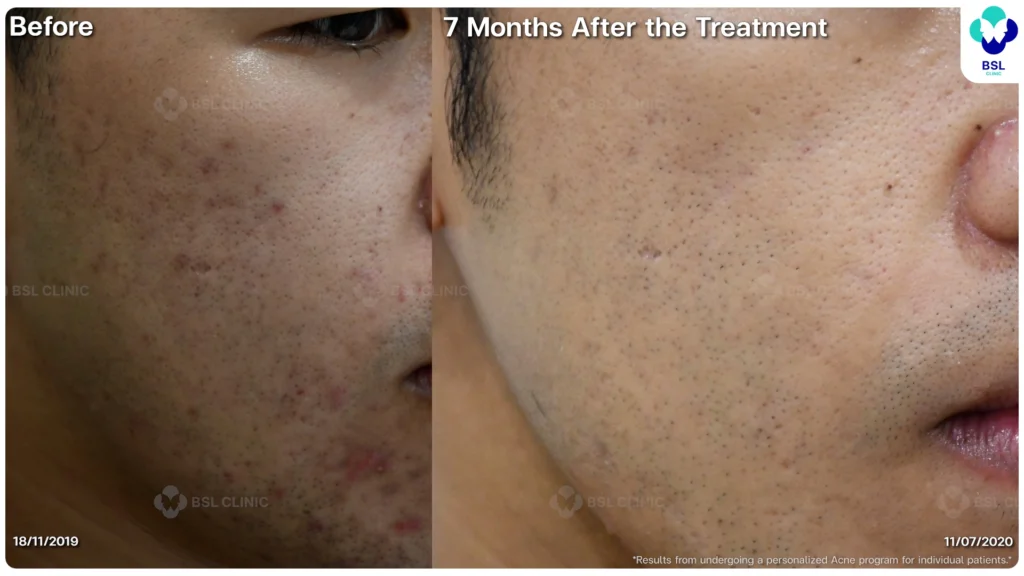 รีวิว ก่อนและหลัง โปรแกรมรักษาสิว รอยสิว หลุมสิว