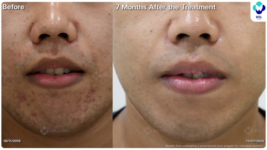 รีวิว ก่อนและหลัง โปรแกรมรักษาสิว รอยสิว หลุมสิว