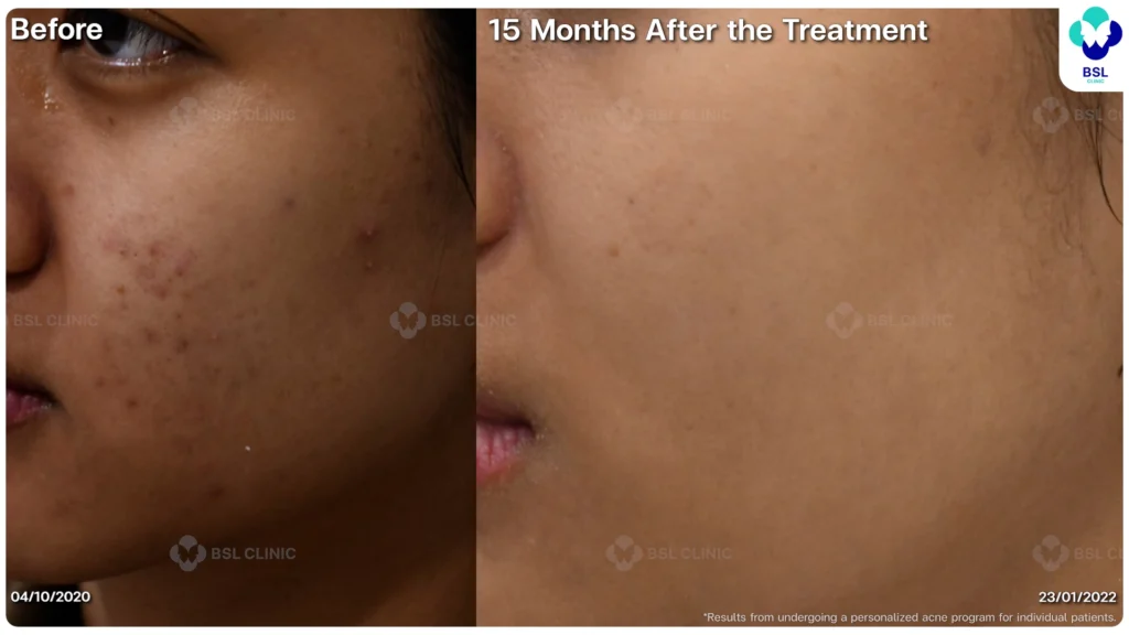 รีวิว ก่อนและหลัง โปรแกรมรักษาสิว รอยสิว หลุมสิว