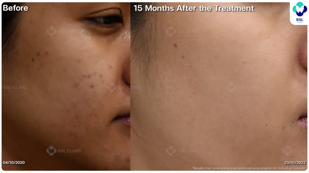 รีวิว ก่อนและหลัง โปรแกรมรักษาสิว รอยสิว หลุมสิว