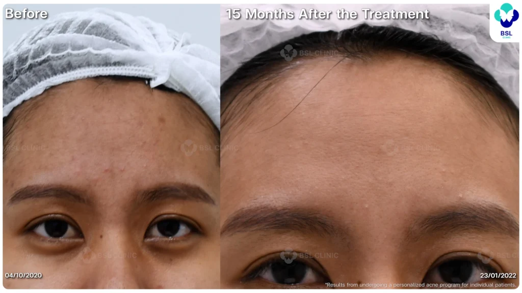 รีวิว ก่อนและหลัง โปรแกรมรักษาสิว รอยสิว หลุมสิว