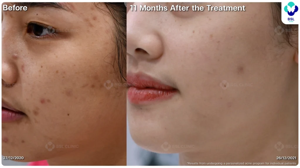 รีวิว ก่อนและหลัง โปรแกรมรักษาสิว รอยสิว หลุมสิว