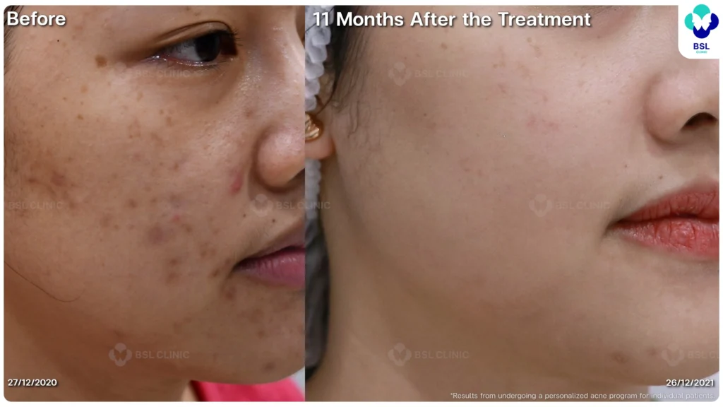 รีวิว ก่อนและหลัง โปรแกรมรักษาสิว รอยสิว หลุมสิว