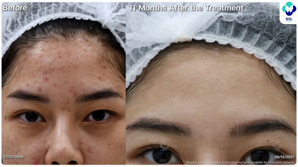 รีวิว ก่อนและหลัง โปรแกรมรักษาสิว รอยสิว หลุมสิว