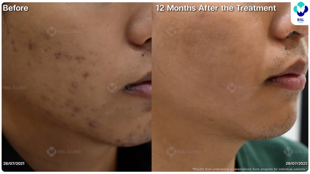 รีวิว ก่อนและหลัง โปรแกรมรักษาสิว รอยสิว หลุมสิว