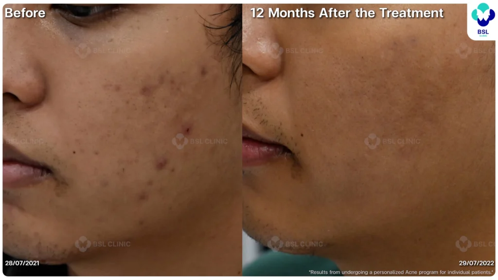 รีวิว ก่อนและหลัง โปรแกรมรักษาสิว รอยสิว หลุมสิว