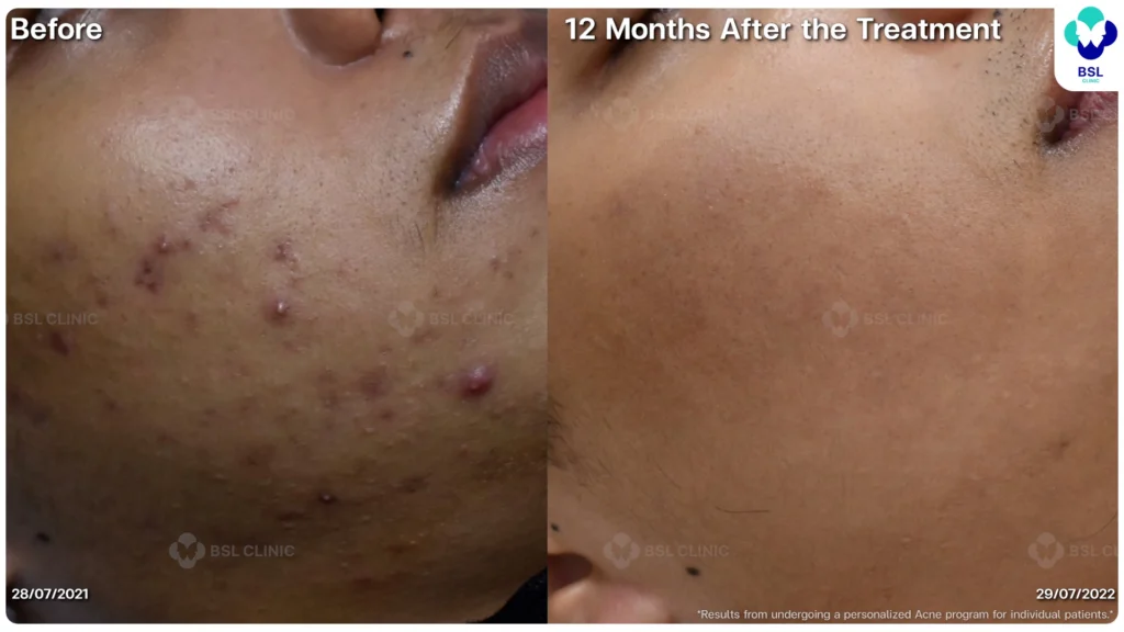 รีวิว ก่อนและหลัง โปรแกรมรักษาสิว รอยสิว หลุมสิว