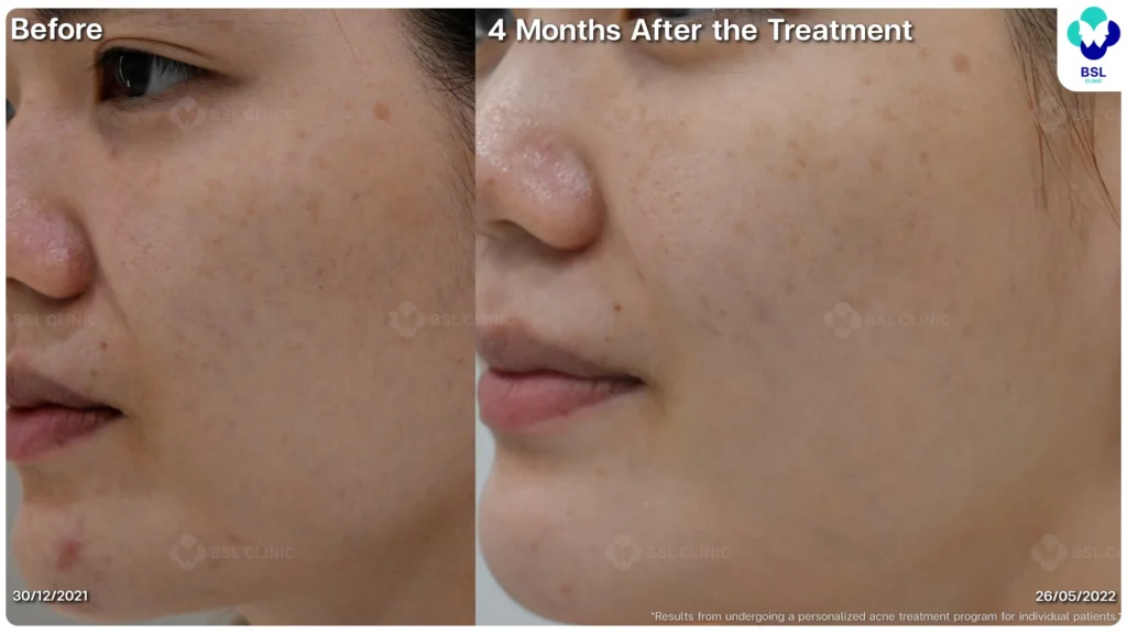 รีวิว ก่อนและหลัง โปรแกรมรักษาสิว รอยสิว หลุมสิว