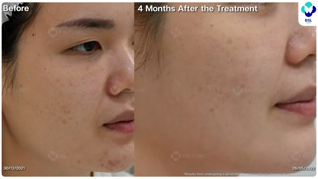 รีวิว ก่อนและหลัง โปรแกรมรักษาสิว รอยสิว หลุมสิว