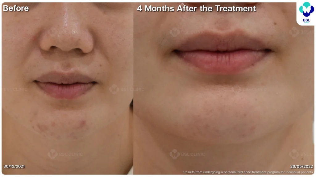 รีวิว ก่อนและหลัง โปรแกรมรักษาสิว รอยสิว หลุมสิว