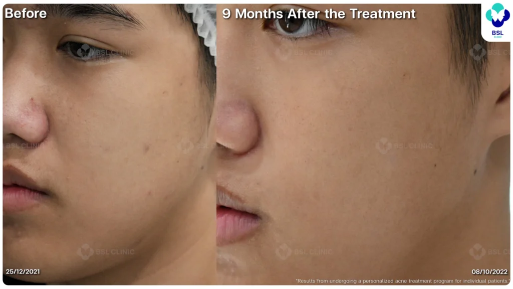 รีวิว ก่อนและหลัง โปรแกรมรักษาสิว รอยสิว หลุมสิว