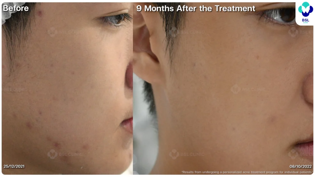 รีวิว ก่อนและหลัง โปรแกรมรักษาสิว รอยสิว หลุมสิว