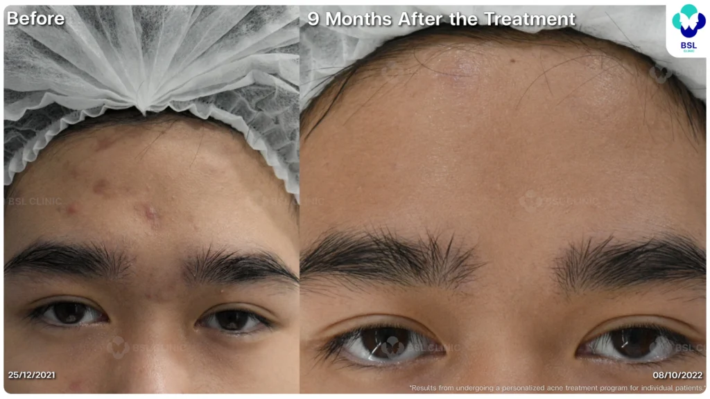 รีวิว ก่อนและหลัง โปรแกรมรักษาสิว รอยสิว หลุมสิว